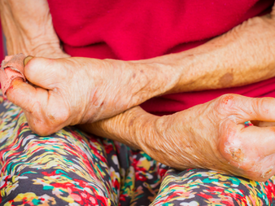 Avanços e Desafios na Política de Reparação da Hanseníase no Maranhão