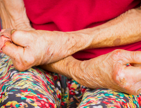 Avanços e Desafios na Política de Reparação da Hanseníase no Maranhão