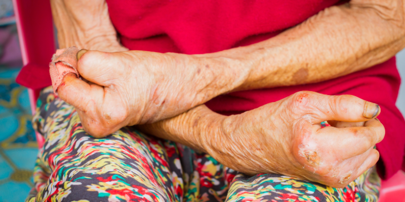 Avanços e Desafios na Política de Reparação da Hanseníase no Maranhão